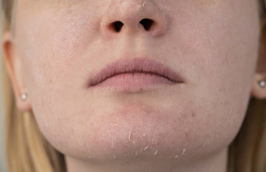 Как лечить сухую кожу: эффективные методы