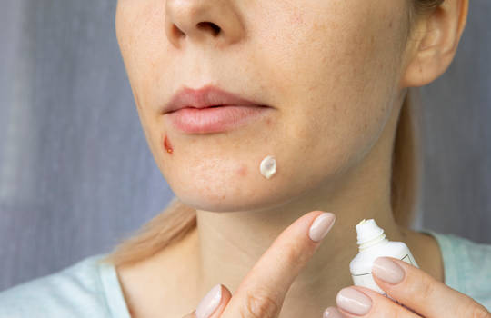 Воспаление на лице: эффективные методы лечения