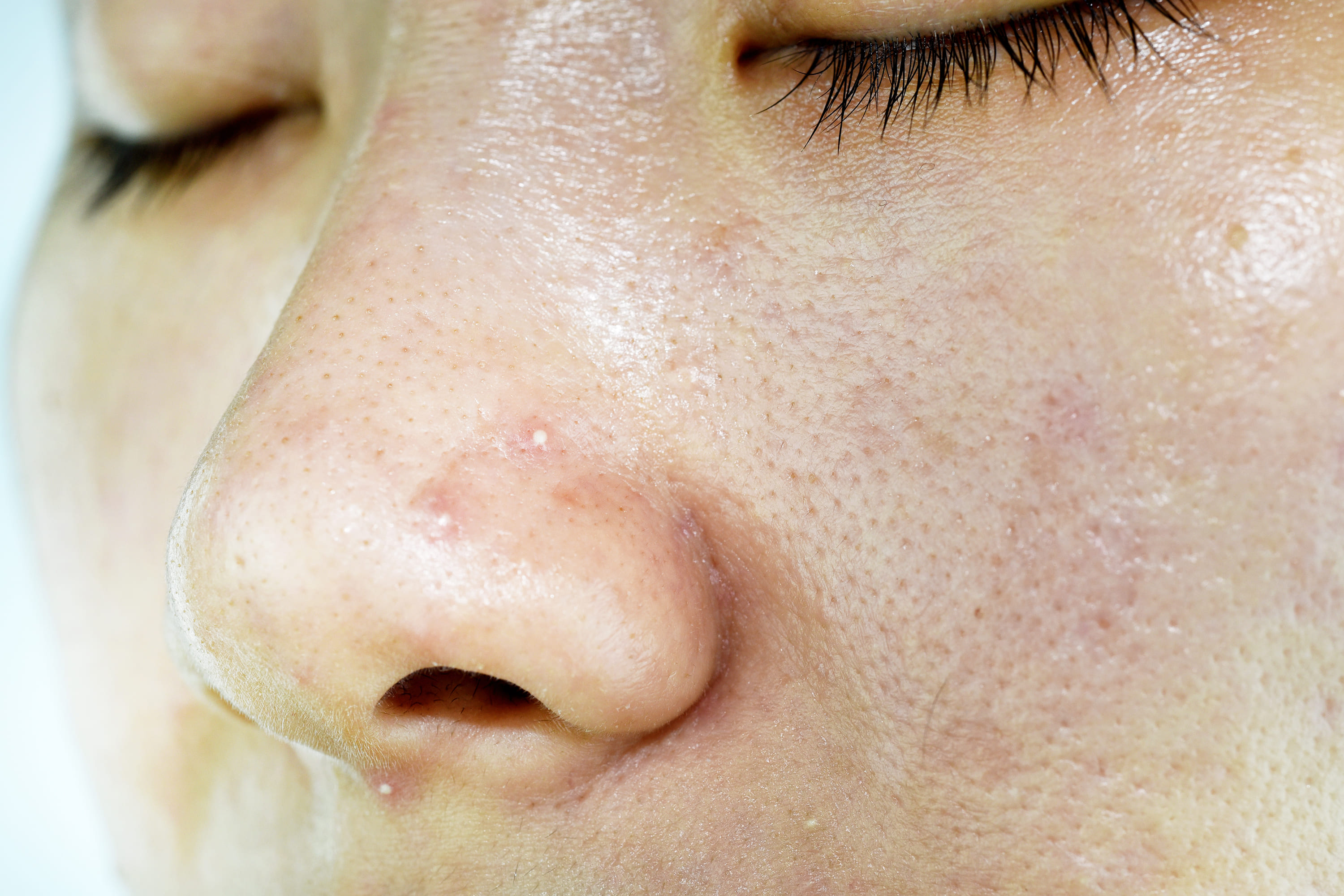 Как избавиться от жирного блеска кожи лица надолго: 7 способов