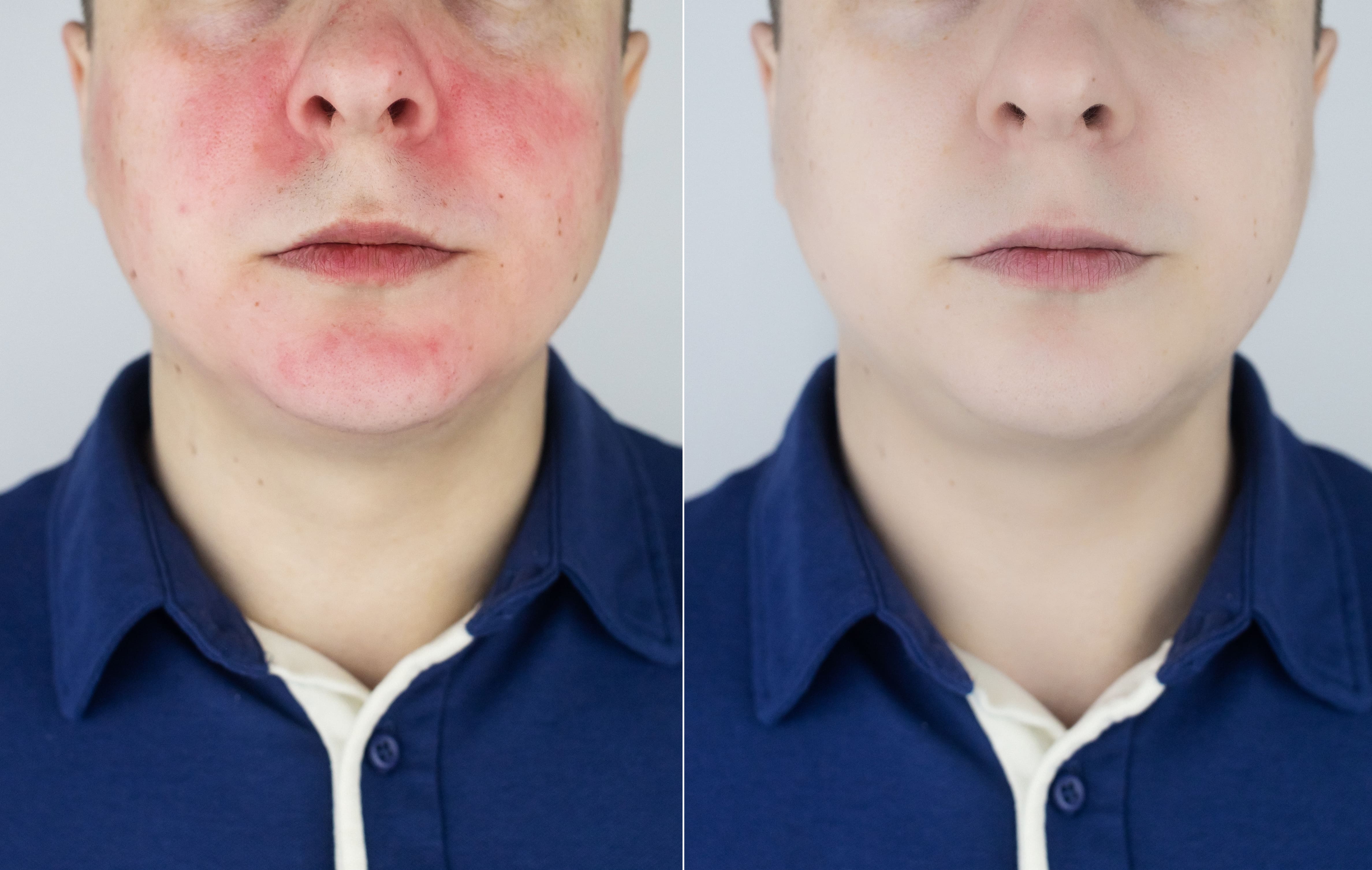 Почему лицо резко краснеет: причины и способы избавления от покраснения кожи лица