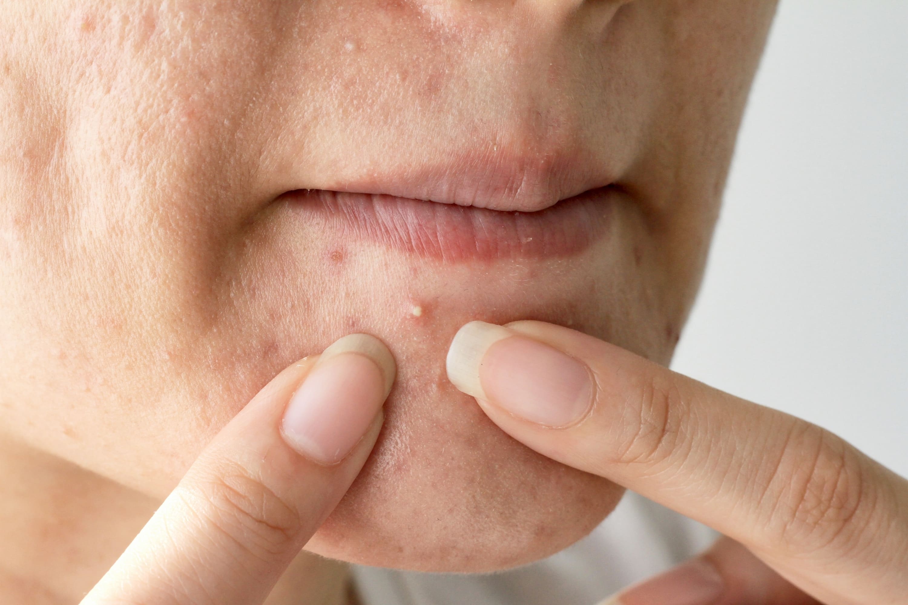 Чем снять воспаление акне на лице: домашние способы и медикаменты | ЛЕМАРК